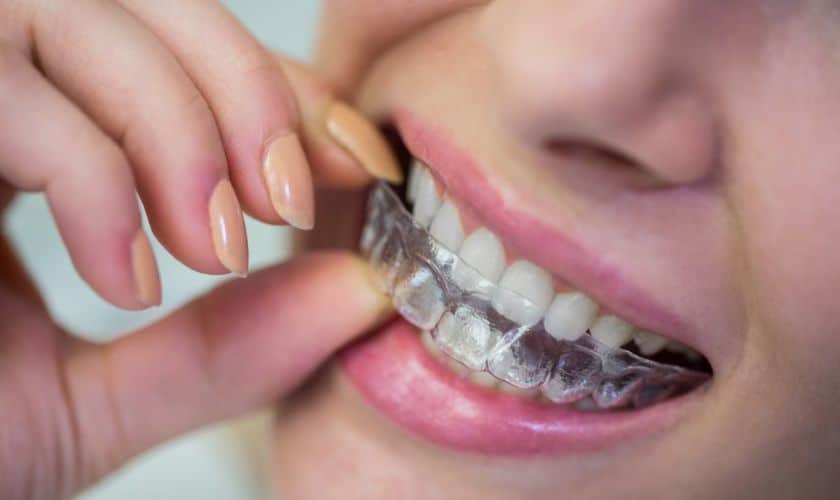 Occlusal Guards: Which One is Right for You?