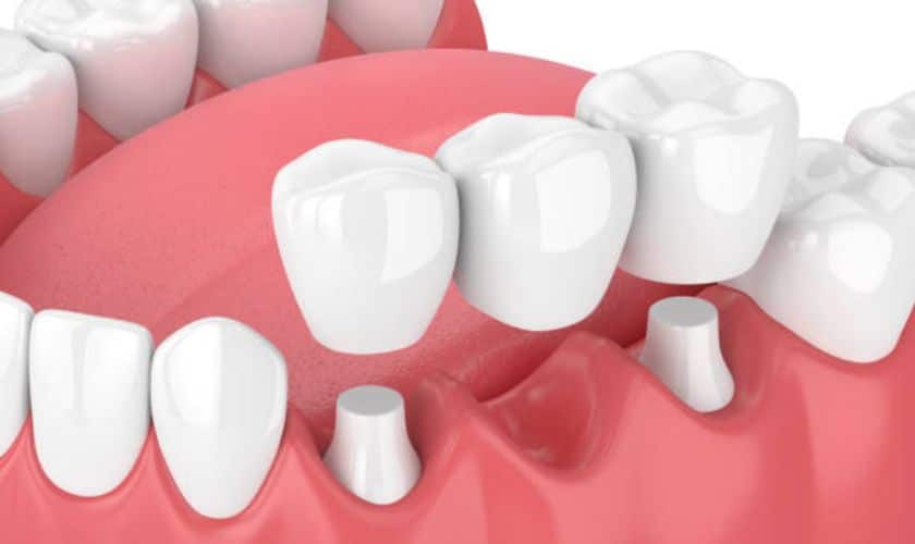 How Do Dental Crowns Restore and Enhance Your Smile Effectively?