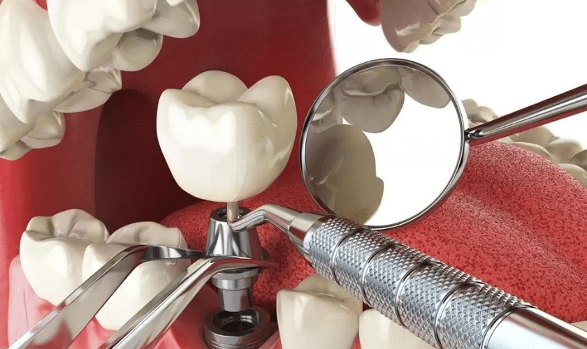 Why Is One Tooth Implant So Expensive?