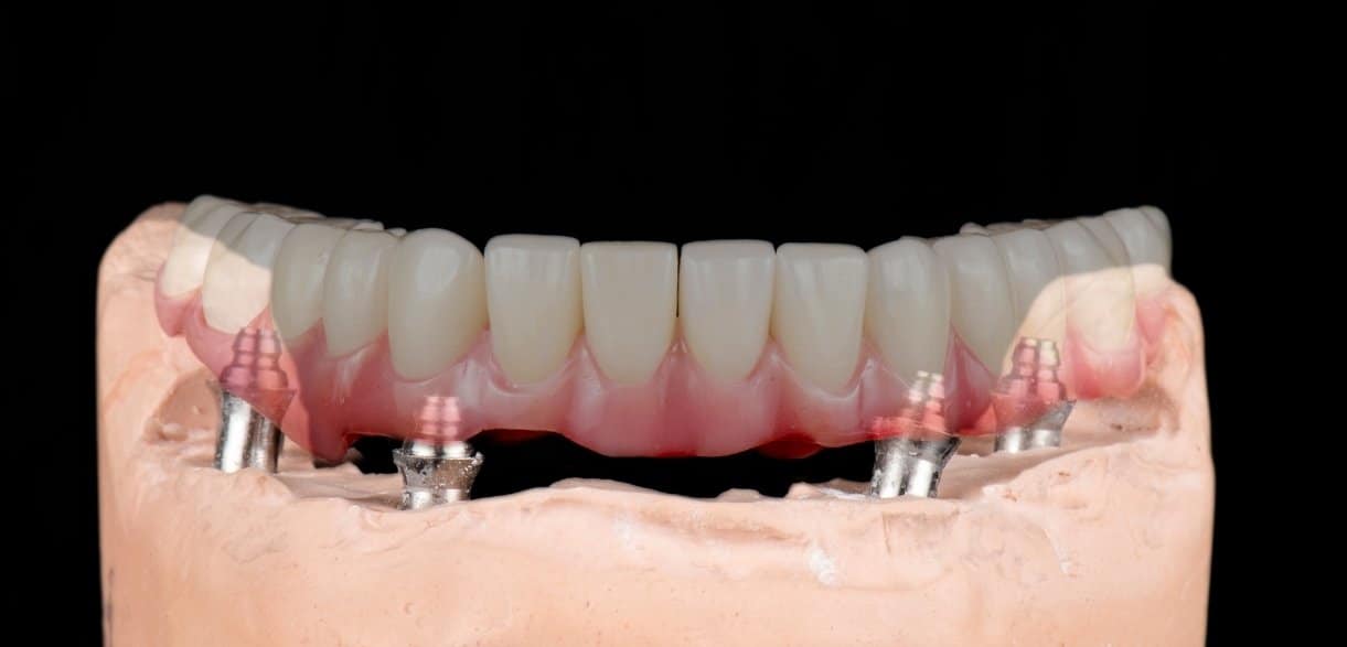 What Is the Healing Time and Recovery Tips After Getting Full Mouth Implants?