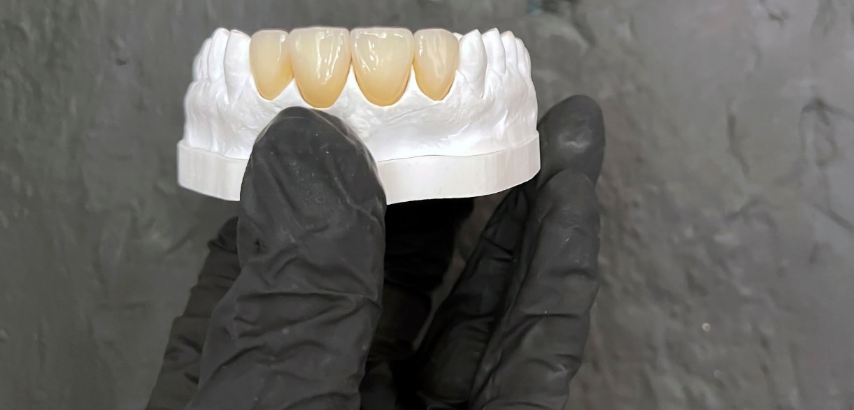 How Crowns & Bridges Together Protect Your Smile?