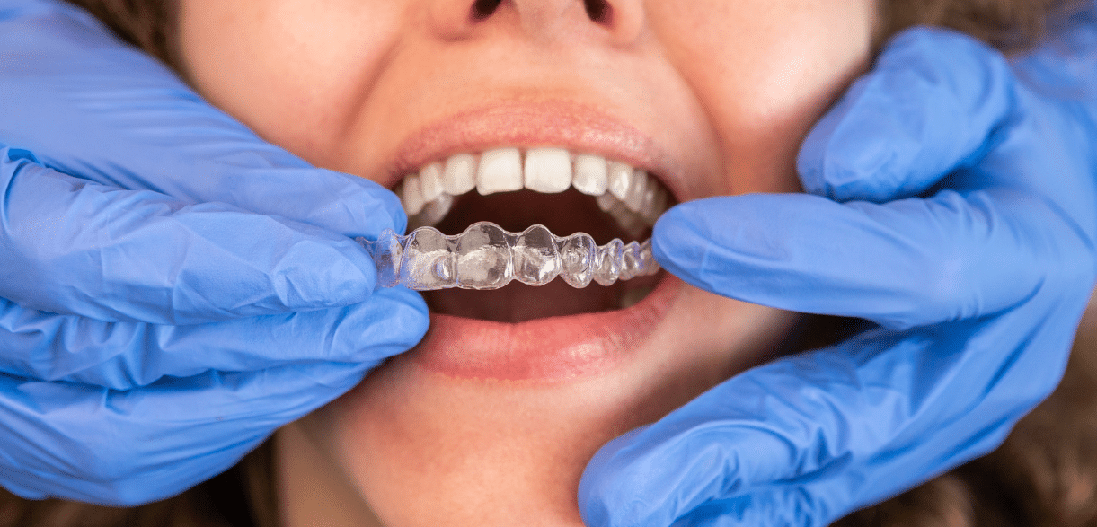 Invisalign for Busy Adults: How Clear Aligners Enhance Life