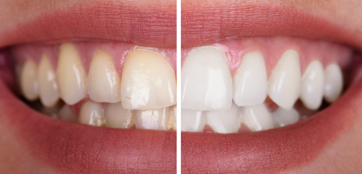How to Remove Black Spots from Teeth at Home