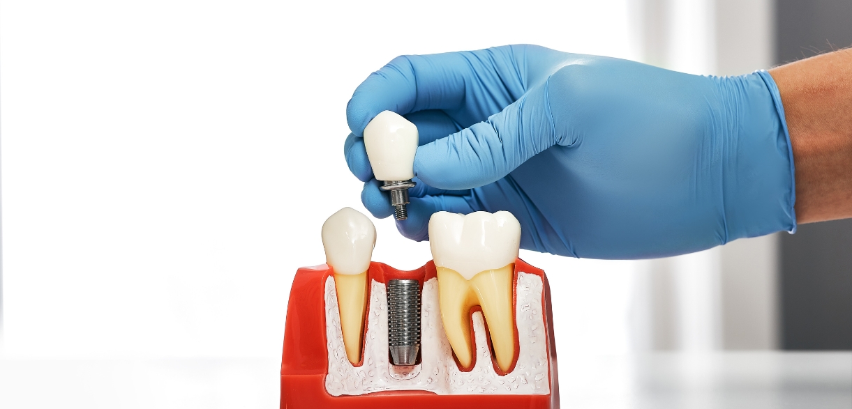 Do Dental Implants Last a Lifetime? What You Should Know Before Getting Them
