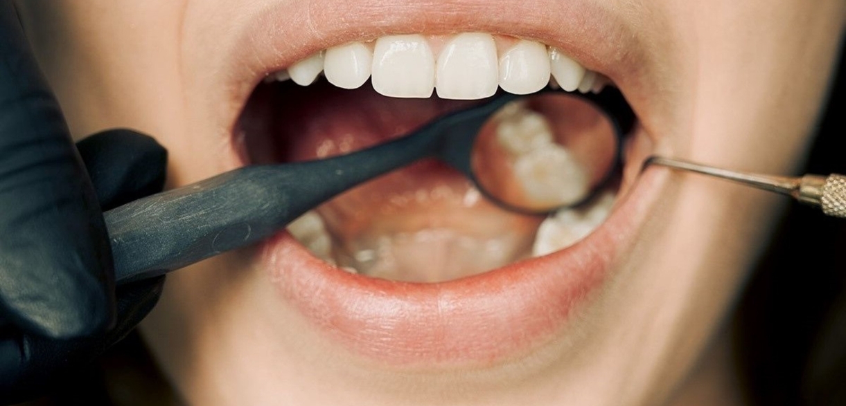 Manage Pain And Discomfort After Wisdom Teeth Removal