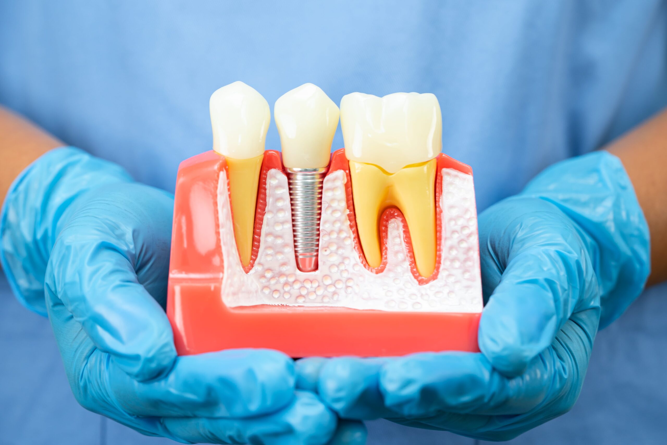 Dental Implants: What You Need to Know