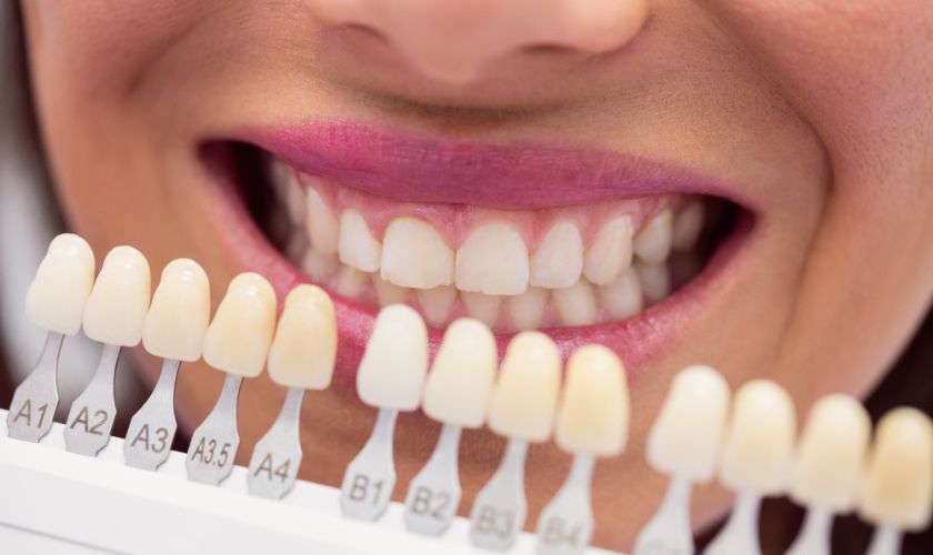 Factors to Determine Your Candidacy for Porcelain Veneers