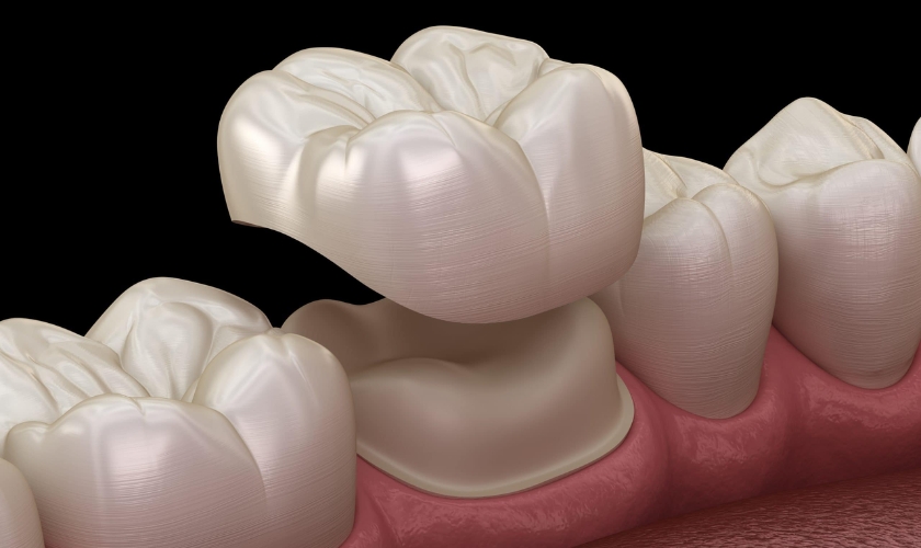 Getting A Broken Crown Repaired Or Replaced
