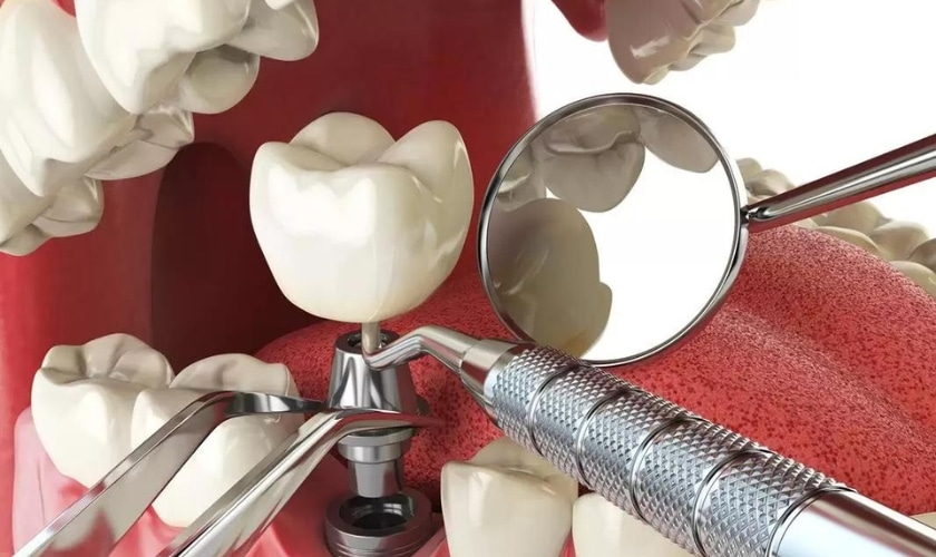 Why Is One Tooth Implant So Expensive