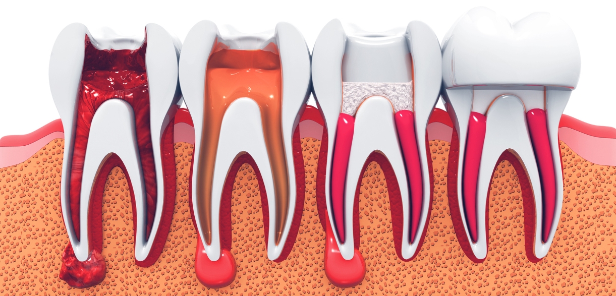 how does diet affect recovery after a root canal procedure