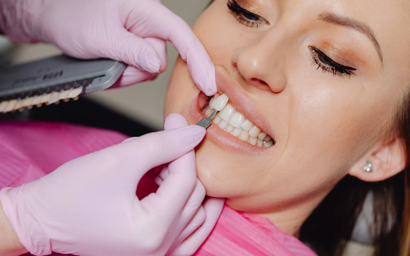 Benefits of Porcelain Veneers