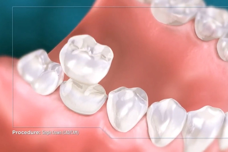 Dental Crowns Recommended by Dentists
