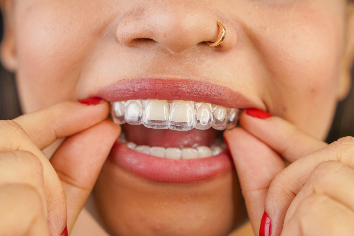 Clear Aligners Fix Overbites and Other Bite Problems